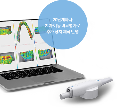 20단계마다 치아 이동 비교평가로 추가 장치 제작 반영