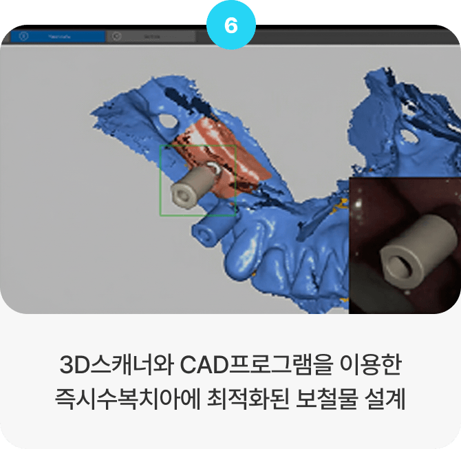 3D스캐너와 CAD프로그램을 이용한 즉시수복치아에 최적화된 보철물 설계