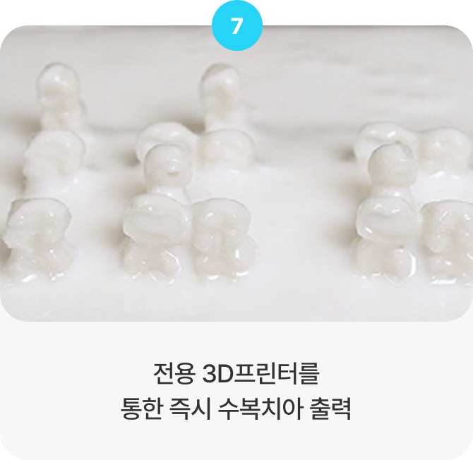 전용 3D프린터를 통한 즉시 수복치아 출력