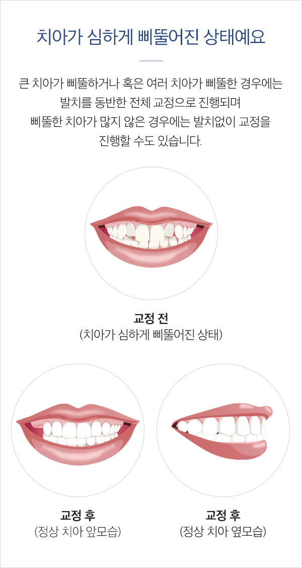 치아가 심하게 삐뚤어진 상태에요