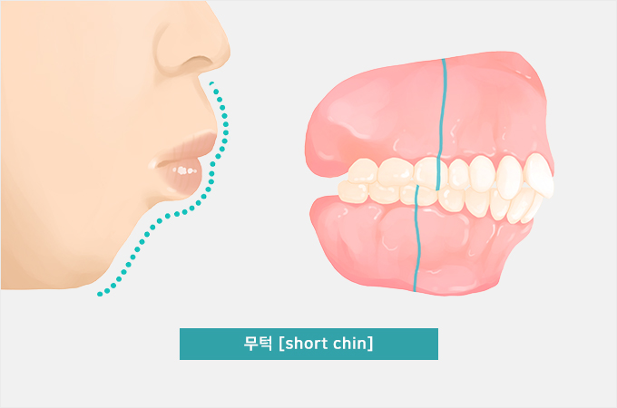 일반교정 | 【대구임플란트 잘하는곳】 | 【이미지치과】 | 【대구치과】